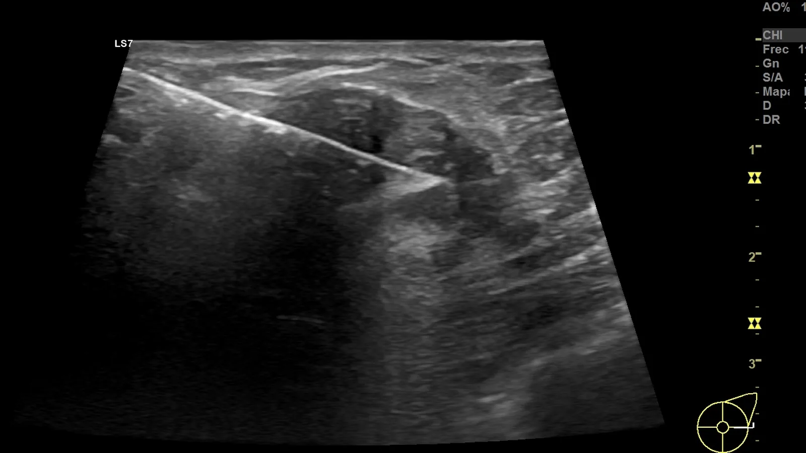Imagen de ultrasonido mamario con la aguja visible durante el procedimiento